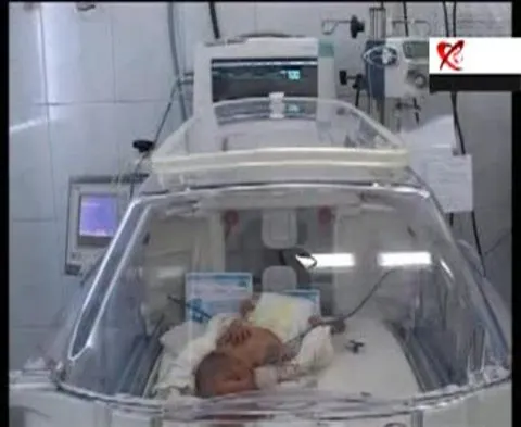 Doi fraţi siamezi din Braşov, uniţi în zona capului, au încetat din viaţă