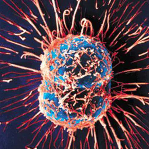 Grupele de sânge ar putea indica riscul de cancer pancreatic, potrivit unui studiu