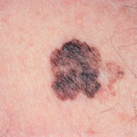 Un nou medicament testat pentru tratarea melanomului s-a dovedit eficient în reducerea tumorilor