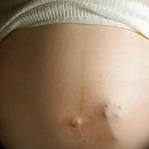 Avorturile nesigure ucid 70.000 de femei anual