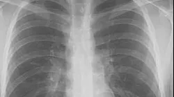 Primele semne ale cancerului pulmonar ar putea fi detectate cu ajutorul unui test respirator -studiu