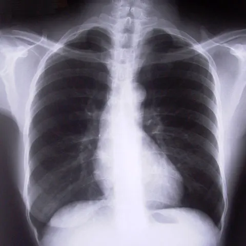 Medicii au descoperit un nou tratament care i-ar putea ajuta pe bolnavii de cancer pulmonar