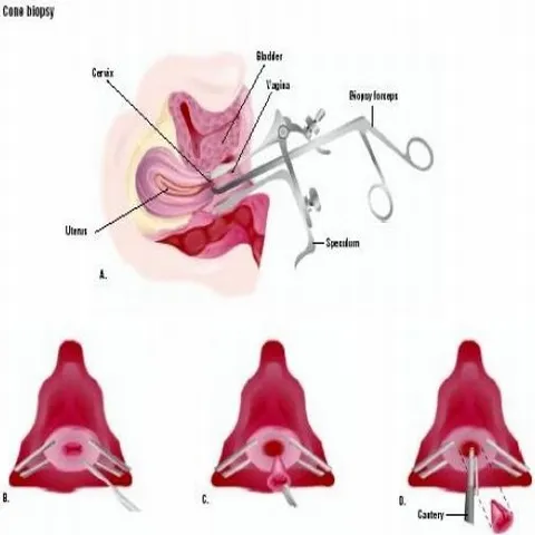 Cancerul cervical ar putea avea acelaşi tratament ca şi osteoporoza sau cancerul la sân