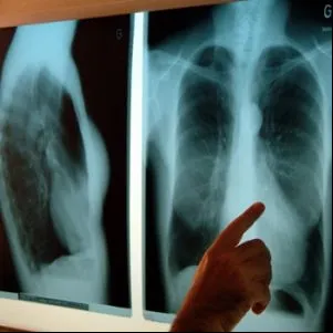 Pacienţii din Covasna deserviţi de doar doi radiologi