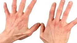 Tratamente naturiste pentru psoriazis