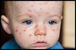 Alertă într-un judeţ din România! Epidemie de varicelă: 70 de copii, bolnavi