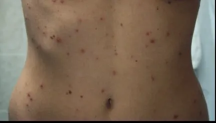 O asistentă medicală a murit după ce a făcut varicelă. Cât de periculoase sunt bolile copilăriei?