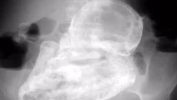 O femeie de 92 de ani din Chile purta de 50 de ani un fetus mumificat 