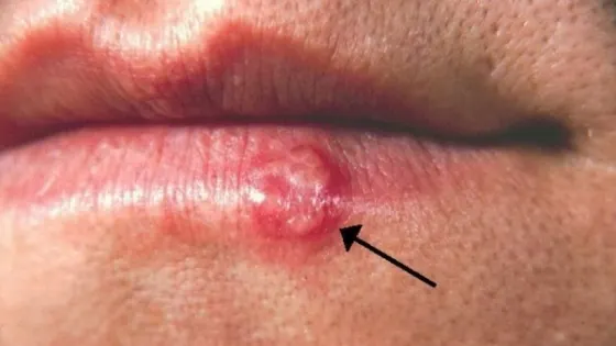 Ce boală gravă poate provoca un banal herpes