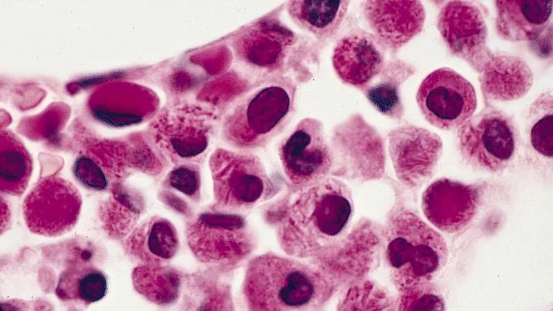 Semne de alarmă care anunță leucemia. Mare atenţie la aceste simptome!