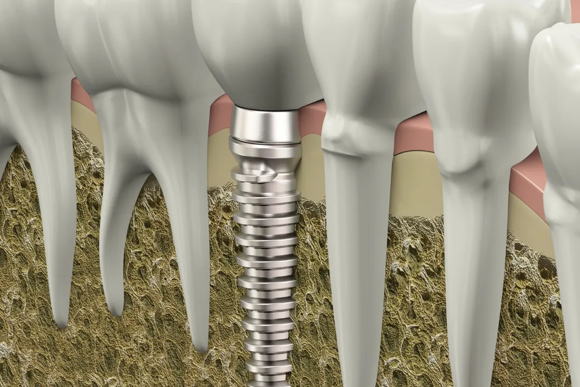SĂNĂTATE. 5 mituri despre implantul dentar