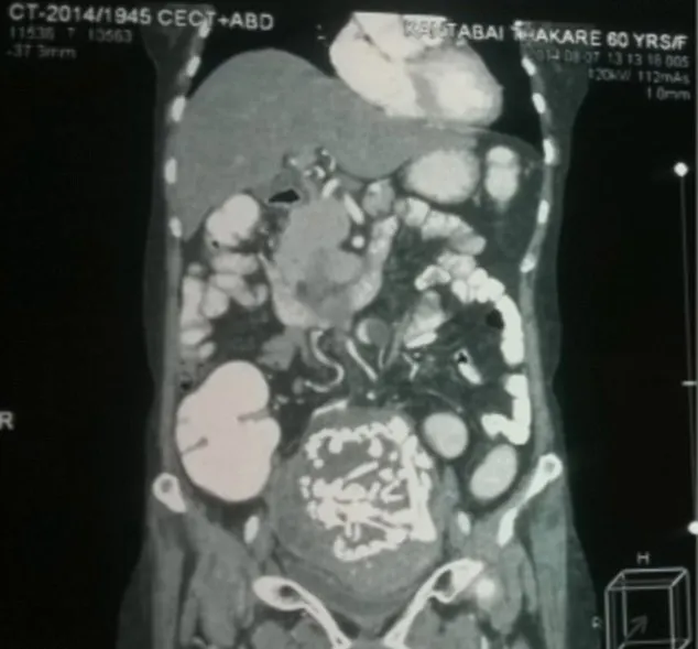 Se plângea de dureri abdominale crunte. Ce au extras medicii din burta unei femei este ŞOCANT