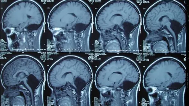 Inexplicabil. A trăit 24 de ani fără creier! Cazul care a uimit medicii
