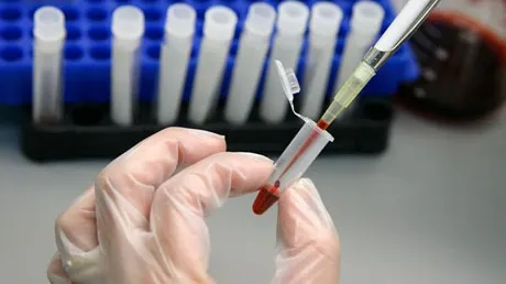 Două foste prietene ale tânărului din Segarcea care avea SIDA, depistate cu HIV
