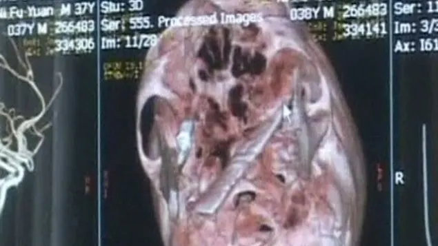 S-a dus la control cu dureri de cap. Medicii AU INGHETAT cand au vazut ce avea IN CRANIU