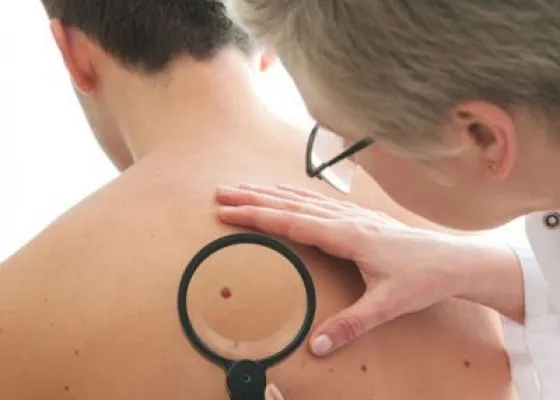 Ce înseamnă fiecare ALUNIȚĂ de pe corp, după medicina orientală