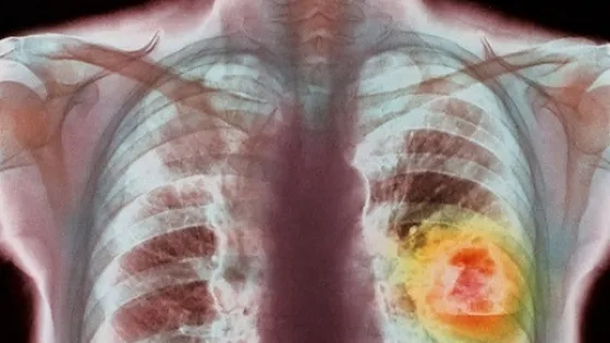 Descoperire medicală: Alimentul care ucide 85% din celulele cancerului pulmonar