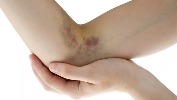 Medicii avertizează asupra unei boli autoimune care afectează mii de femei tinere şi copii