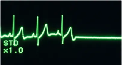 Semne că vei face infarct