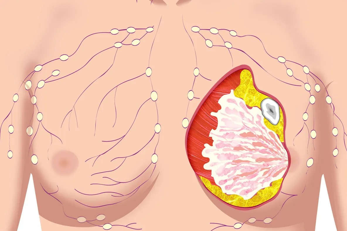 5 simptome atipice ale cancerului mamar