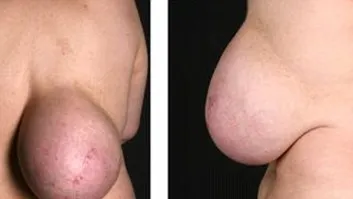 Povestea emoţionantă a femeii cu un sân pe spate. Medicii s-au îngrozit când au văzut-o