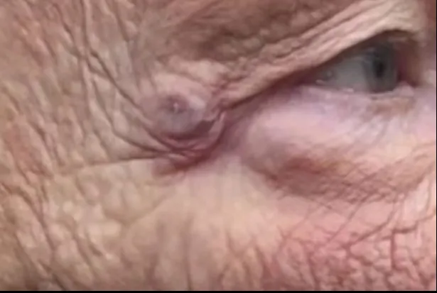 Avea o pată gri lângă ochi. Când a început s-o stoarcă, a ieșit un ditamai monstrul - VIDEO