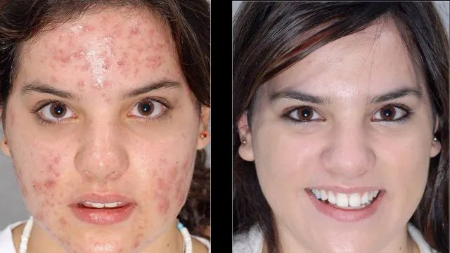 Avea faţă ciuruită de coşuri, aşa că a apelat la un leac natural. Efectul a fost spectaculos