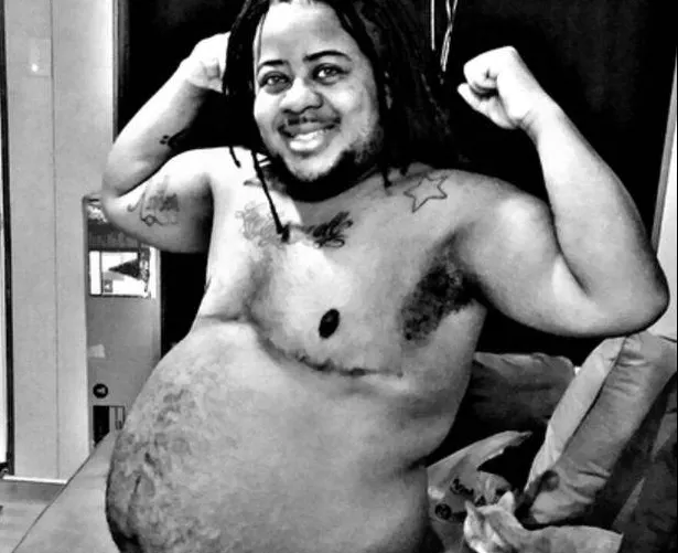 Credea că a făcut burtă de la bere. La câteva zile a aflat ceva care l-a lăsat fără cuvinte