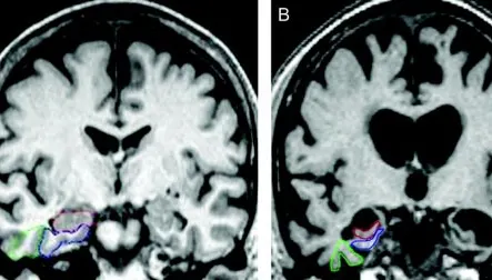 Descoperire surprinzătoare. Ce au văzut medicii în creierul unui bolnav de Alzheimer