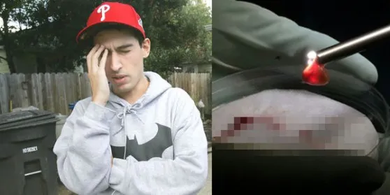 Şocul medicilor, după ce un tânăr student s-a plâns de dureri de cap. Ce au găsit în creierul său