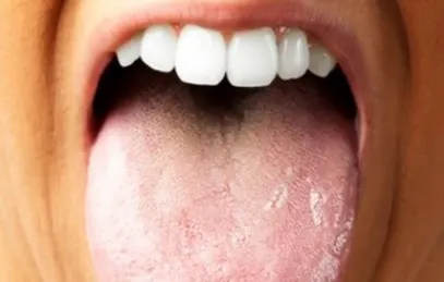 Ai limba crăpată la vârf? Mergi URGENT la medic! E vorba despre o boală cumplită!