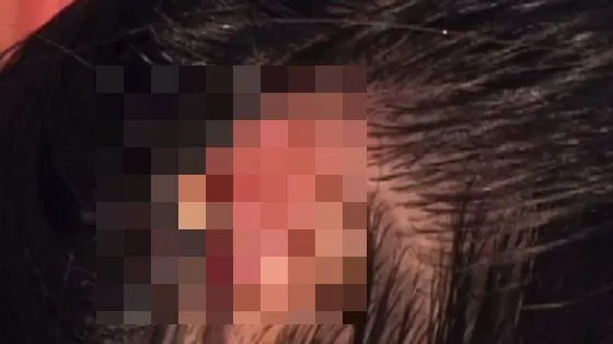 Se scărpina mereu în cap. A rămas stupefiată după ce a fost la medic și i-a scos asta din scalp