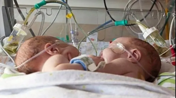 Siamezele născute acum o lună la Constanţa au murit. Fetiţele aveau o singură inimă
