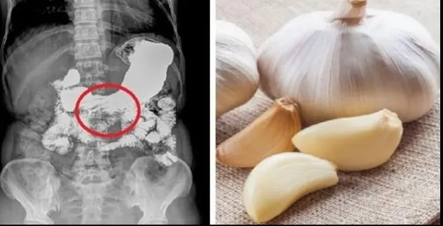 A mâncat usturoi cu miere pe stomacul gol, timp de 7 zile. Efectele au fost peste așteptările ei