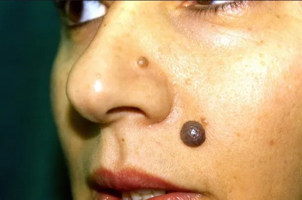 Scapă de aluniţe, negi şi puncte negre cu aceste remedii naturale