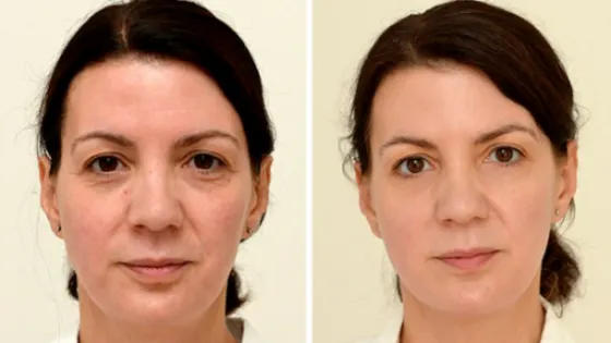 Cum a reuşit această femeie să scape de riduri. Secretul pe care orice femeie trebuie să îl ştie