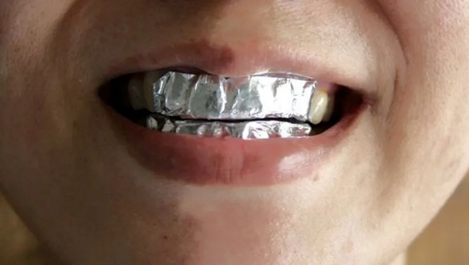 Şi-a pus folie de aluminiu pe dinţi şi a stat aşa timp de o oră, în fiecare zi. Efectul este magic