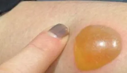 I-a apărut o băşică gălbuie pe picior, iar după ce a spart-o a ieşit...