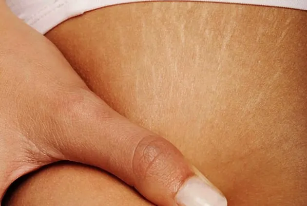 7 remedii naturale anti-vergeturi, cu efect garantat 