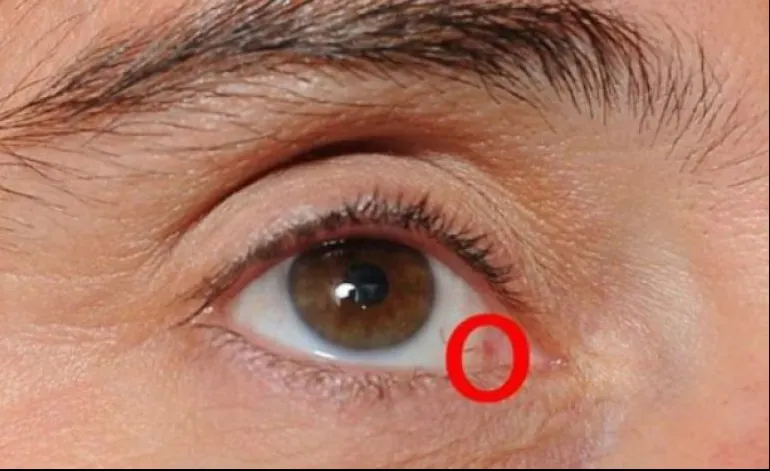 Ce se întâmplă când îți apare așa ceva la ochi. Nu mai sta! Anunță imediat doctorul