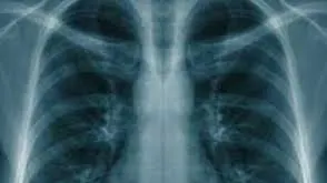 Uleiul care ucide celulele cancerului de plămâni. Are un puternic efect antiseptic
