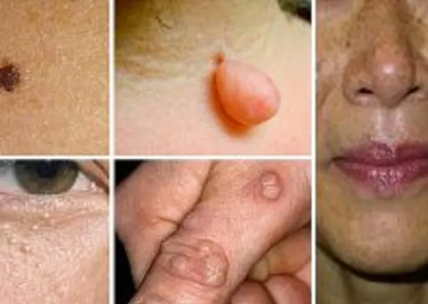 DESCOPERIRE: Este probabil cel mai eficient remediu natural pentru alunițe și negi