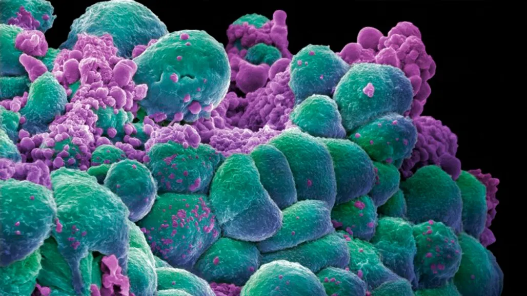 Medicii au descoperit uleiul magic care distruge 90% din celulele canceroase în două zile