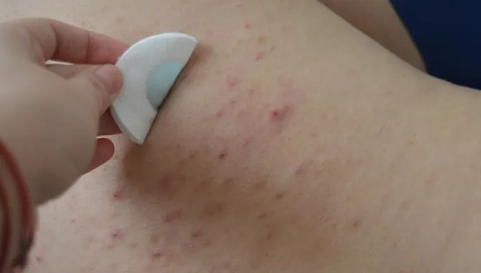 Cum scapi de coșurile de pe spate. Cele mai ieftine ingrediente. Le ai în casă