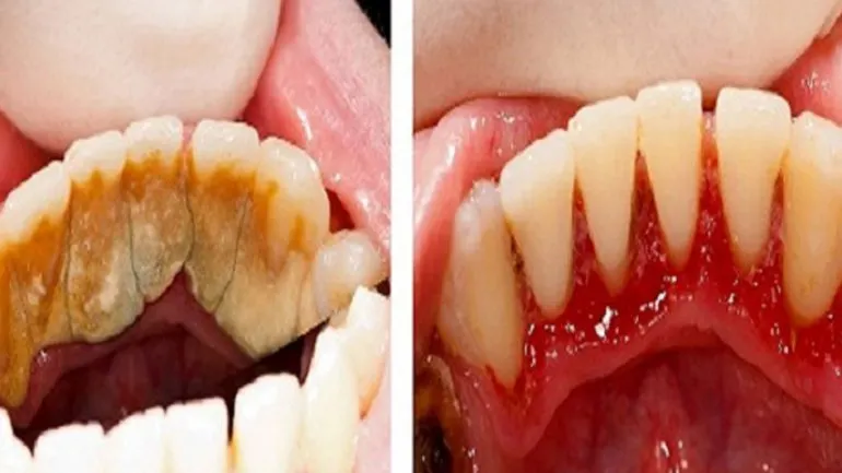 Cum scapi de tartru cu 3 alimente banale. Dentiștii ți-au ascuns mereu asta!