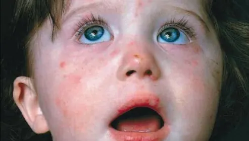 Epidemie de rujeolă în România: 675 de copii bolnavi în 23 de judeţe. Trei copii au murit 