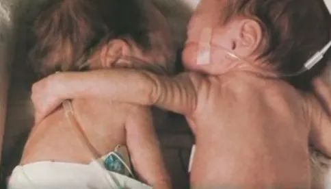 O nou-născută şi-a îmbrăţisat sora geamănă care era pe moarte. Ce a urmat a şocat lumea medicală!