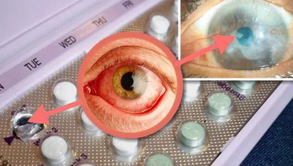 Specialiştii avertizează: Anticoncepţionalele duc la orbire! Cum este posibil