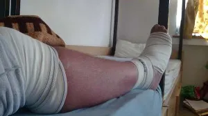 Entorsele de gleznă nu trebuie ignorate, avertizează medicii. Ce complicații pot apărea pe termen lung