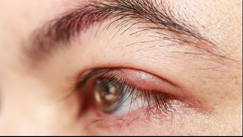 Ce este interzis să faci dacă ai urcior la ochi